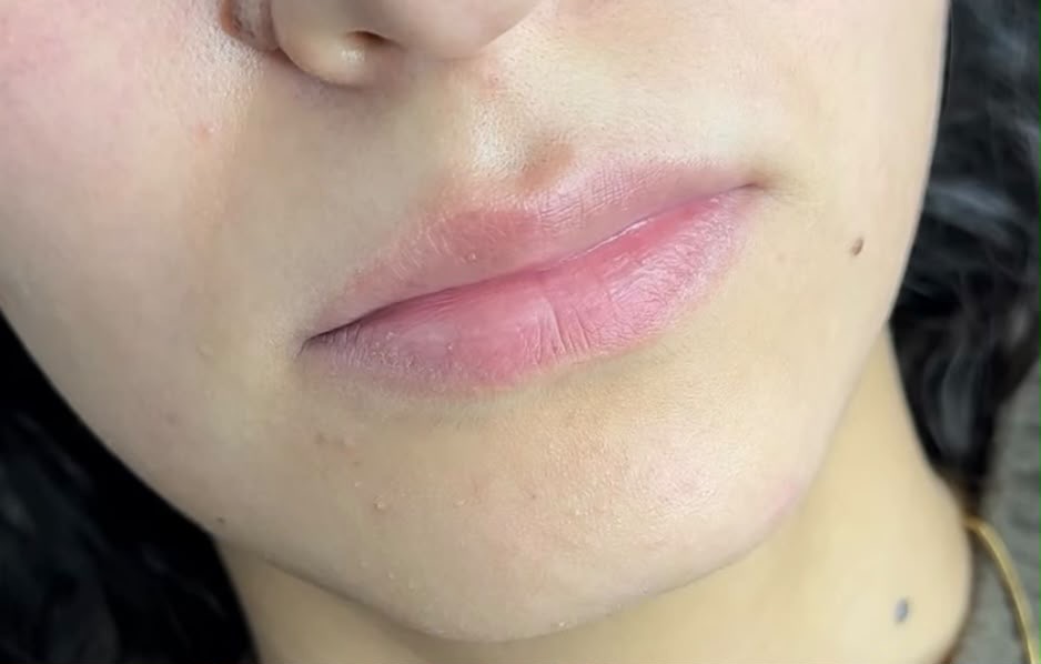 Lip treatment result